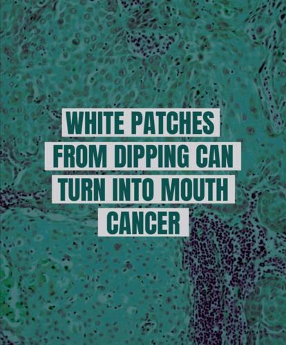 White patches from dipping can turn into mouth cancer